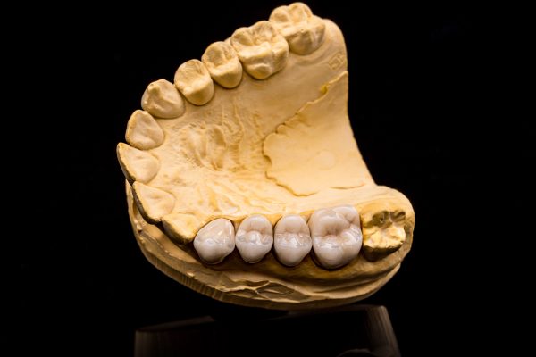 artificial-teeth-PT5UFWX